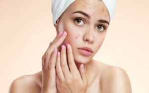 cach tri mun trung ca 1