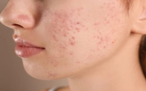 dieu tri mun trung ca 1