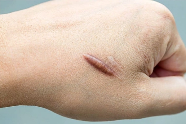 Ăn thịt bò có bị sẹo lồi không? Nên kiêng gì cho cơ địa dễ bị sẹo 1 an thit bo co bi seo loi khong 1