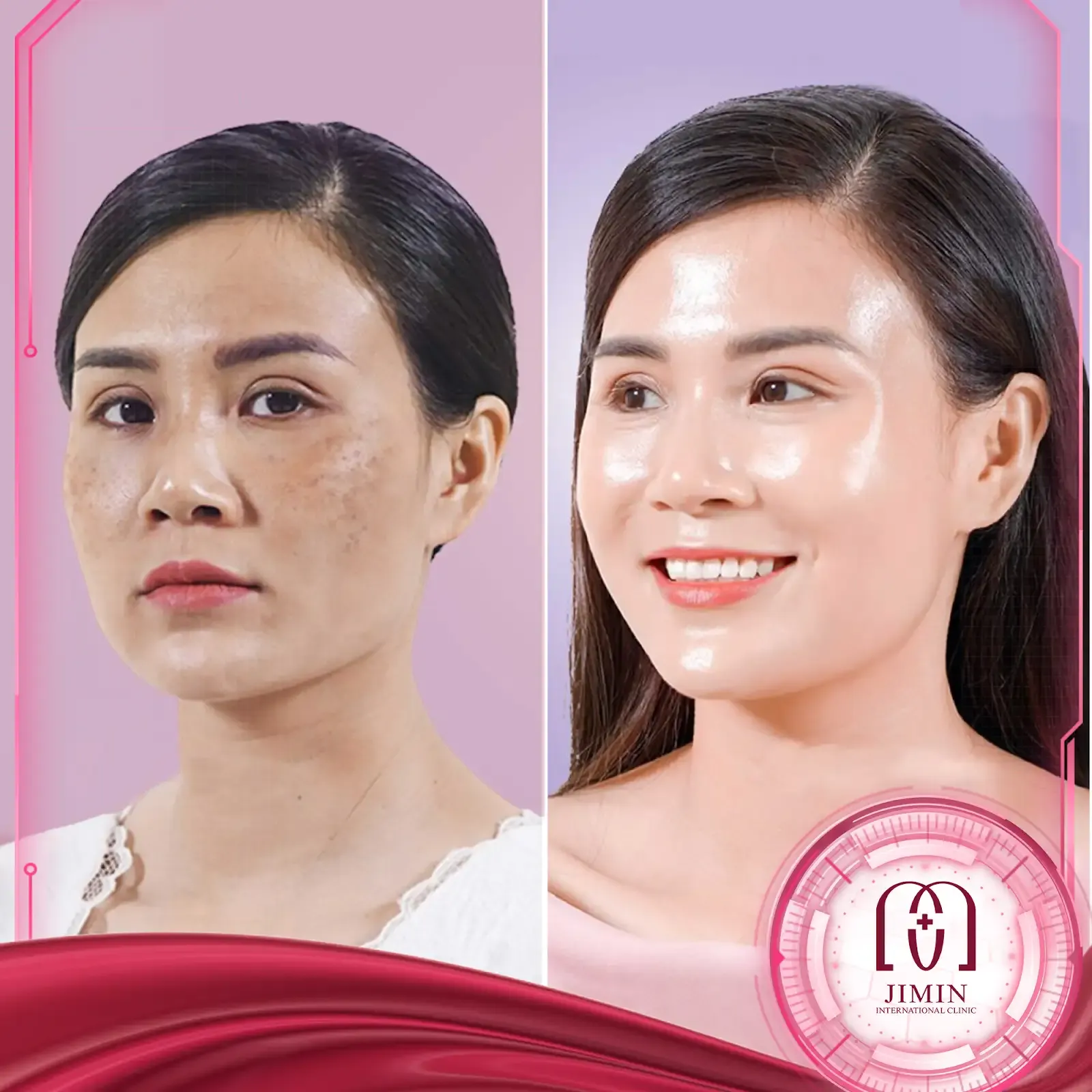 Công nghệ Laser tiên tiến trong điều trị nám da tại Phòng khám chuyên khoa phẫu thuật thẩm mỹ Jimin 4 Hiệu quả vượt trội sau 1 liệu trình điều trị tại Jimin Clinic