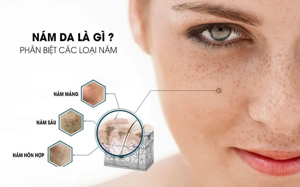 Công nghệ Laser tiên tiến trong điều trị nám da tại Phòng khám chuyên khoa phẫu thuật thẩm mỹ Jimin 1 Nhận biết các loại nám phổ biến hiện nay