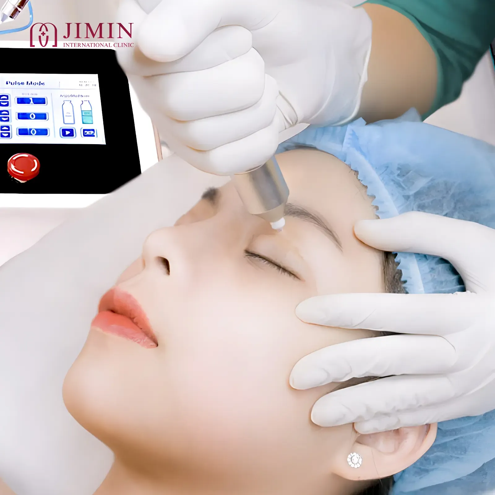 Phẫu thuật thừa da mi dưới: Giải pháp trẻ hóa đôi mắt tại Phòng khám chuyên khoa phẫu thuật thẩm mỹ Jimin 2 Máy công nghệ cao giúp tối thiểu xâm lấn nhưng mang lại kết quả thẩm mỹ tối ưu
