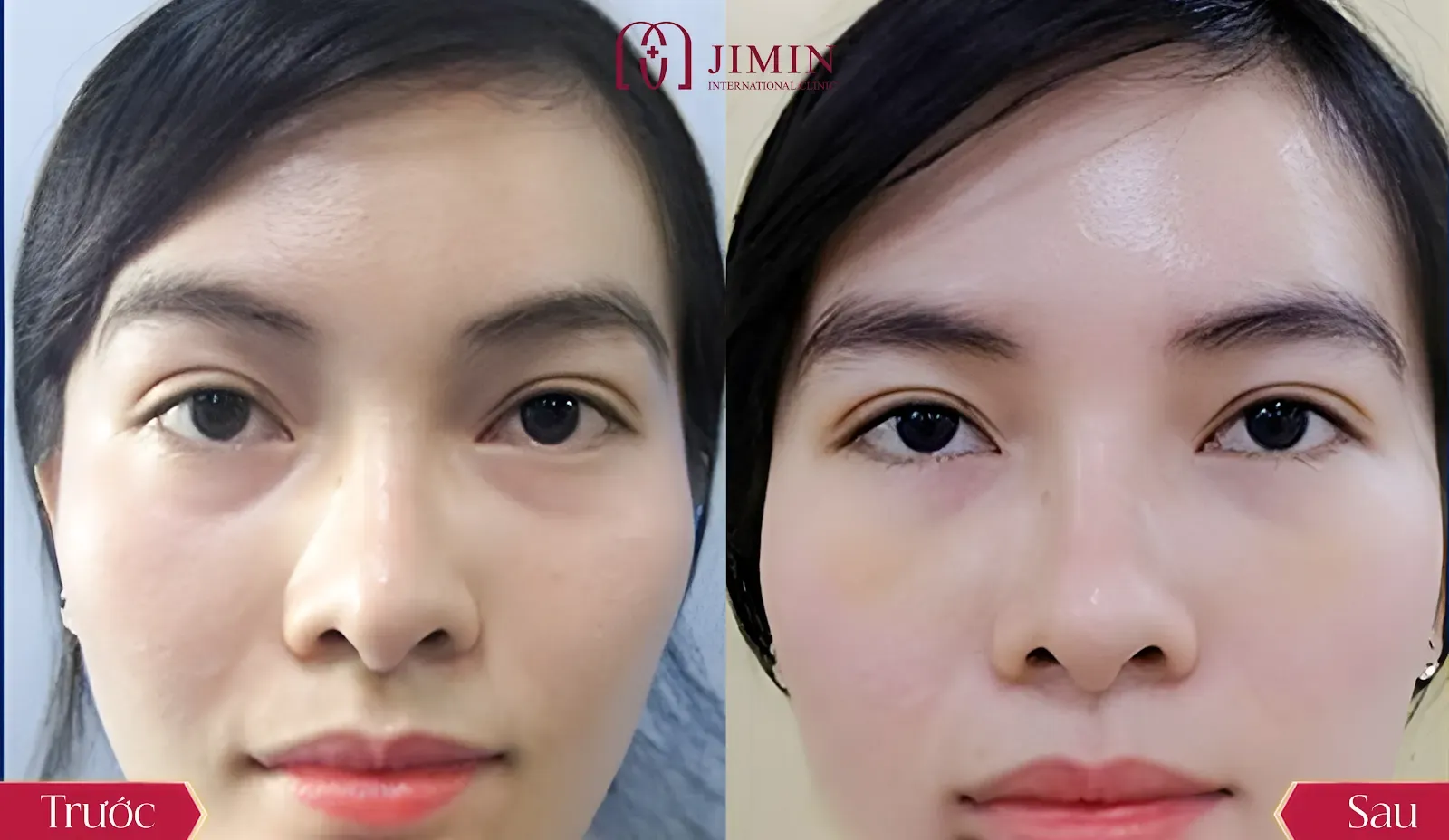 Phẫu thuật thừa da mi dưới: Giải pháp trẻ hóa đôi mắt tại Phòng khám chuyên khoa phẫu thuật thẩm mỹ Jimin 4 Kết quả vượt mong đợi chỉ trong thời gian ngắn, không đau, không nghỉ dưỡng